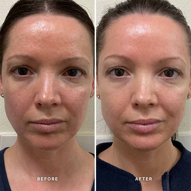Alpha-H Vitamin B Serum with 5% Niacinamide | 4 week trial before and after