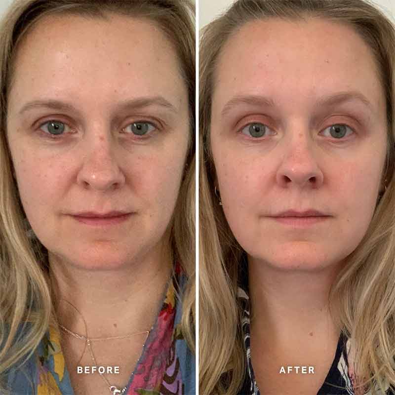 Alpha-H Vitamin A Serum with 0.5% Retinol | facial serum using vitamin a for 4 weeks | before and after using vitamin a skincare