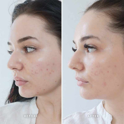 Alpha-H Vitamin B Serum with 5% Niacinamide | before and after 4 week trial