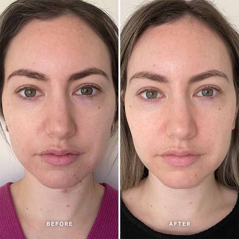 Alpha-H Vitamin B Serum with 5% Niacinamide | before and after using vitamin b