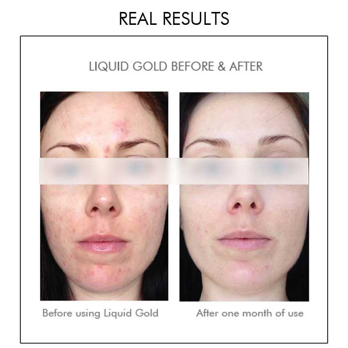 Alpha-H Liquid Gold | before and after 