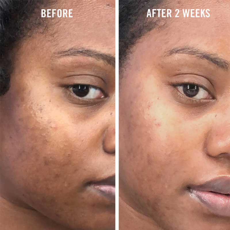 First Aid Beauty Facial Radiance Niacinamide Dark Spot Serum | Hyperpigmentation | Dark spots | Acne Scars | Before and after