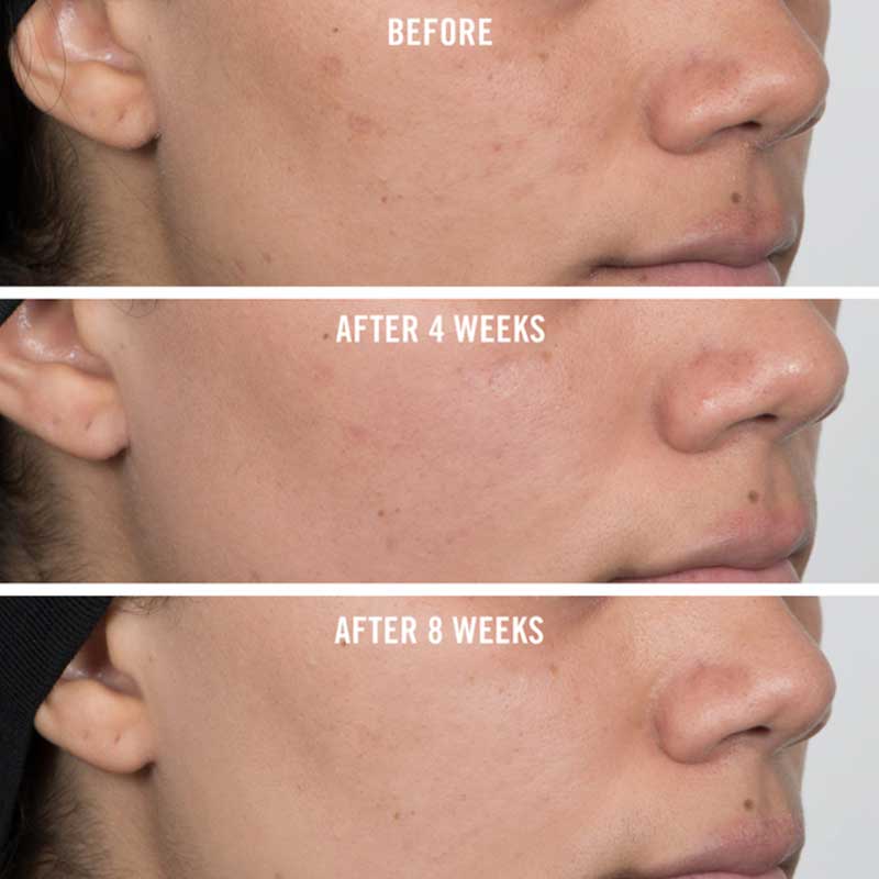 First Aid Beauty Facial Radiance Niacinamide Dark Spot Serum | Hyperpigmentation | Dark spots | Blemishes | Discolouration | Sunspots | Before and after