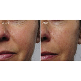 products/Murad_Rapid_Collegen_Infusion_Before_After.jpg