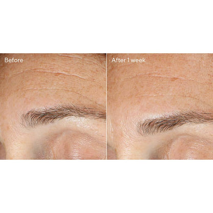 Murad Replenishing Multi-Acid Peel | results before and after