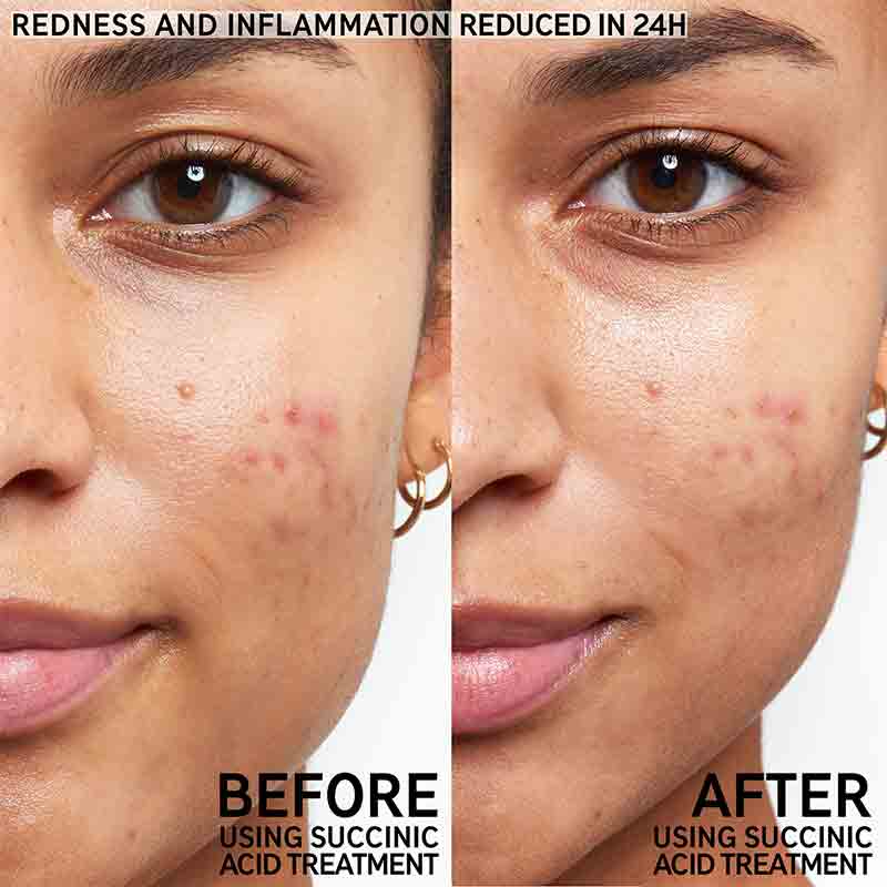The Inkey List Succinic Acid Blemish treatment | clear blemishes