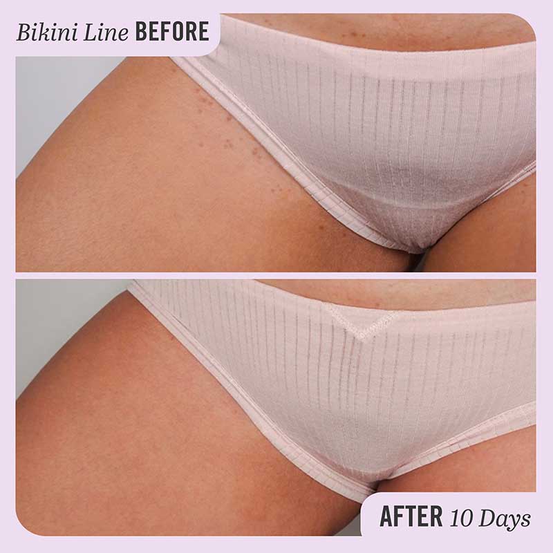 How to Tell If That Bump on Your Bikini Line Is an Ingrown Hair