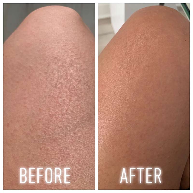 Keratosis Pilaris | before and after using first aid beauty bump eraser