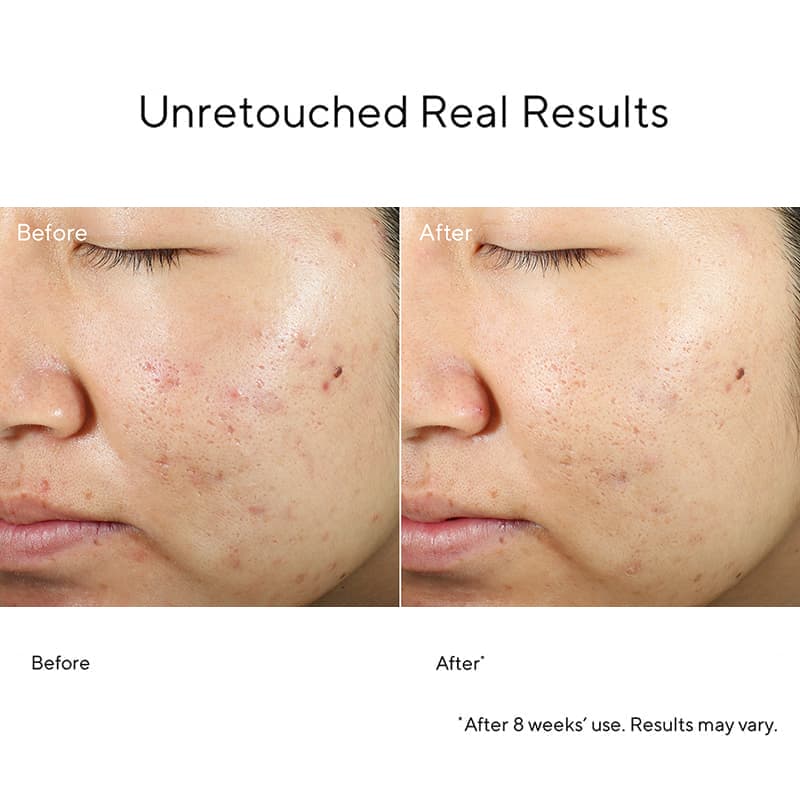 Murad InvisiScar Before & After | Spot & Blemish Scar Treatment