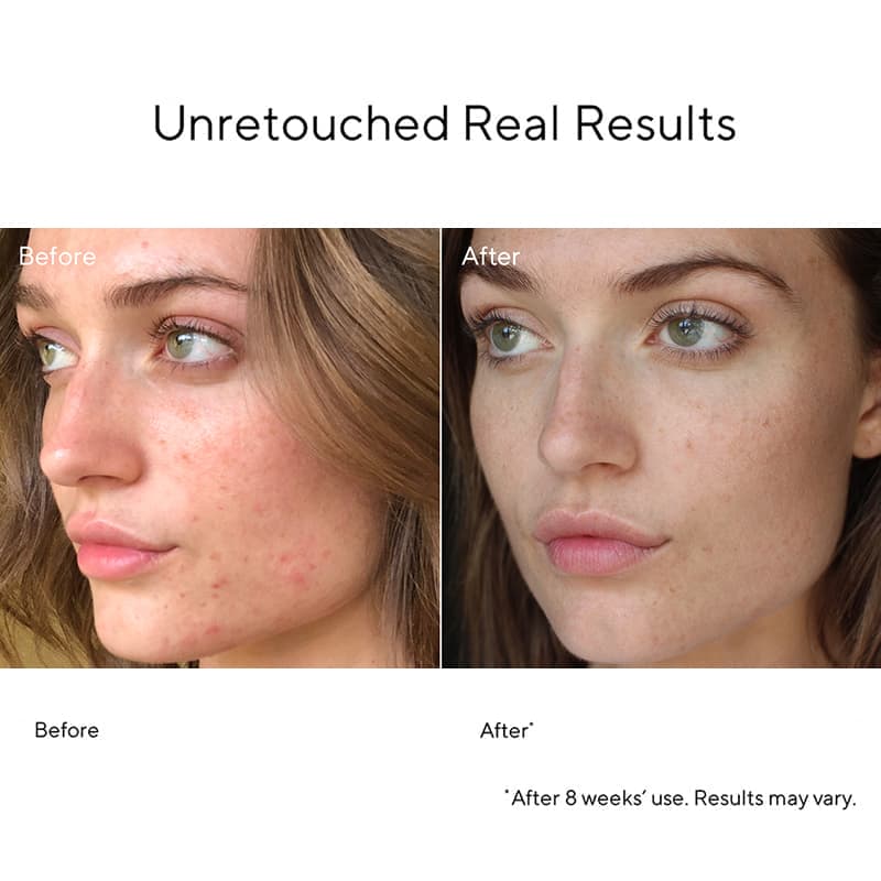 Murad InvisiScar Before & After | Spot & Blemish Scar Treatment