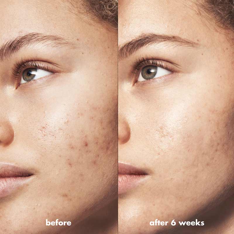 e.l.f. Blemish Breakthrough Acne Clarifying Cleanser | elf products | best elf skincare | elf skincare products | acne cleanser | acne prone skincare 